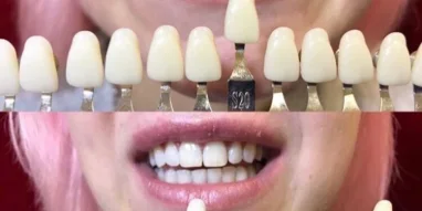 Студия отбеливания зубов White&Smile фотография 7